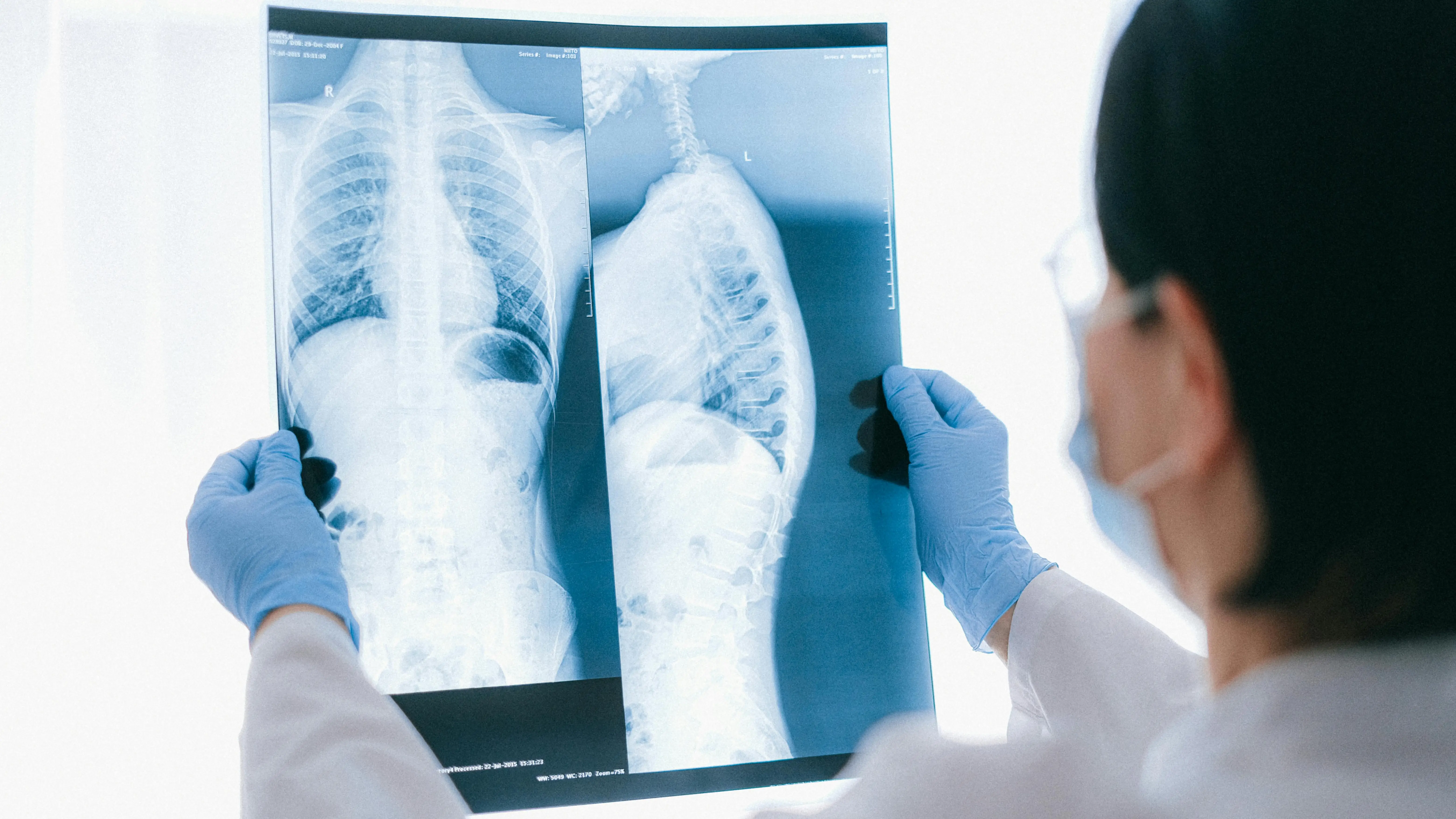 Światowy Dzień Gruźlicy: Peng Liyuan wezwała do globalnych działań w walce z gruźlicą